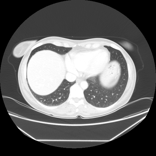 Original VENOUS CT scan