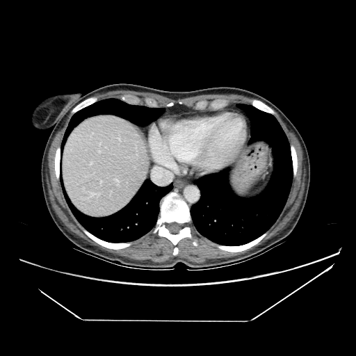 Original VENOUS CT scan