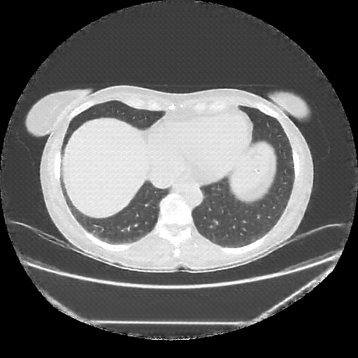 Reconstructed NATIVE CT scan (cycle consistency)
