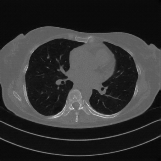 Reconstructed NATIVE CT scan (cycle consistency)