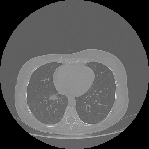 Original NATIVE CT scan (input)