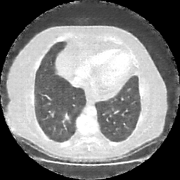 Reconstructed NATIVE CT scan (cycle consistency)