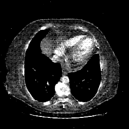 Reconstructed NATIVE CT scan (cycle consistency)
