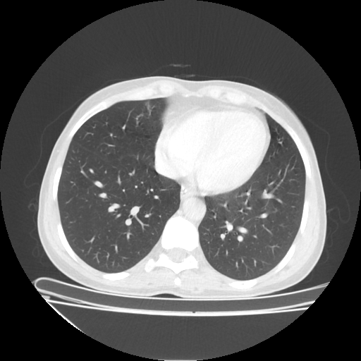 Original VENOUS CT scan