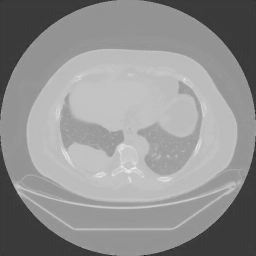 Reconstructed NATIVE CT scan (cycle consistency)