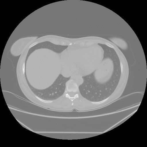 Original NATIVE CT scan (input)