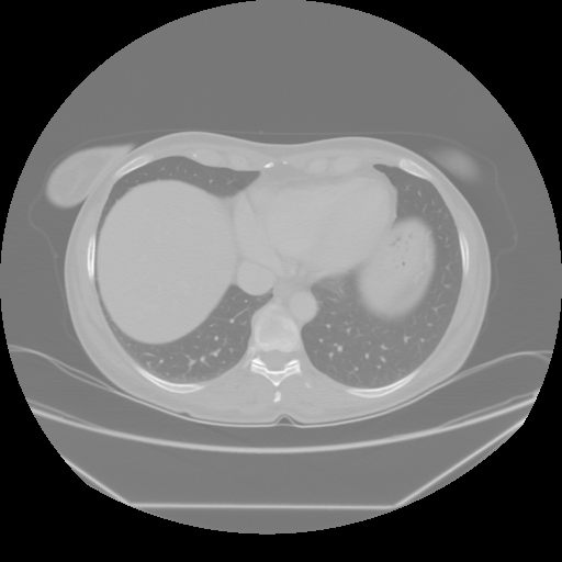 Original VENOUS CT scan