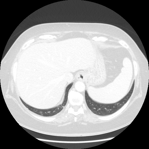 Original VENOUS CT scan