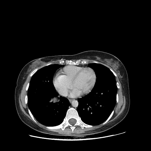 Original VENOUS CT scan