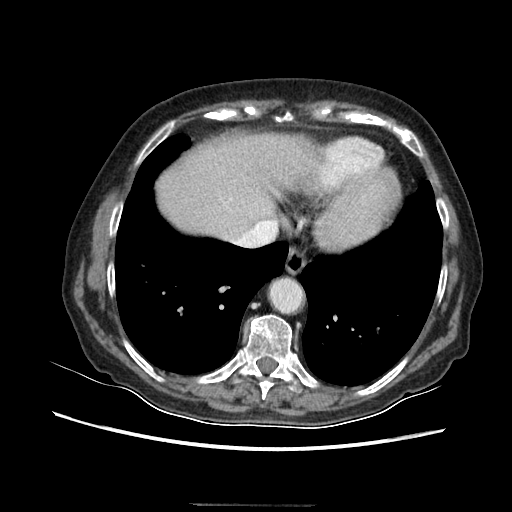 Original VENOUS CT scan