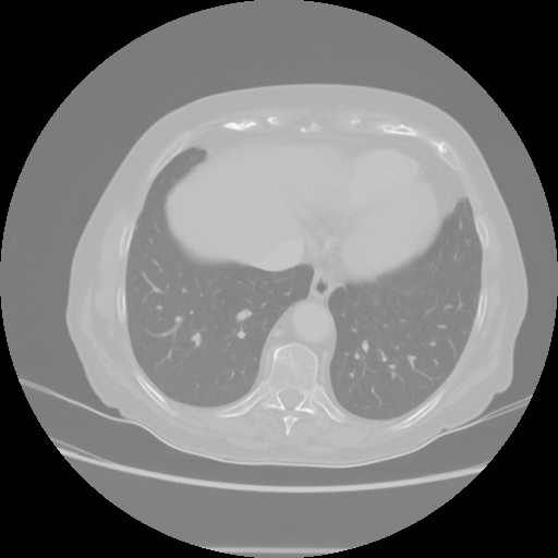 Original VENOUS CT scan
