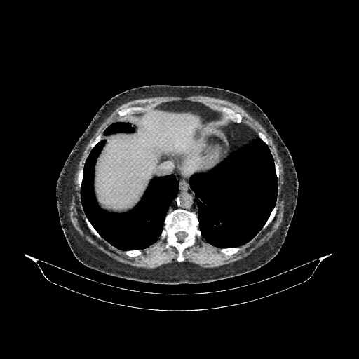 Generated VENOUS CT scan (A→B translation)