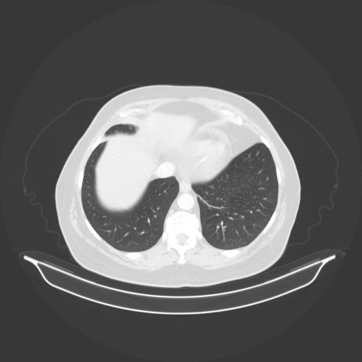 Original VENOUS CT scan