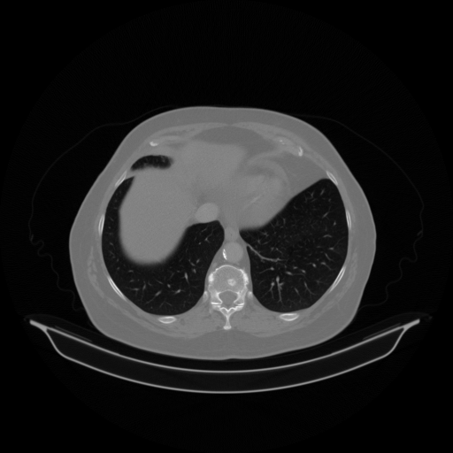 Original VENOUS CT scan
