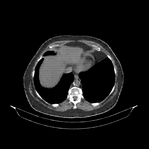 Reconstructed NATIVE CT scan (cycle consistency)
