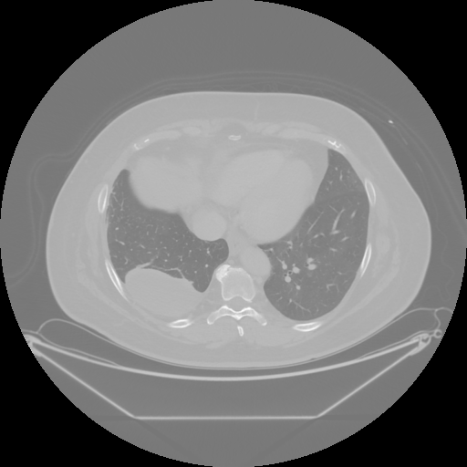 Original VENOUS CT scan