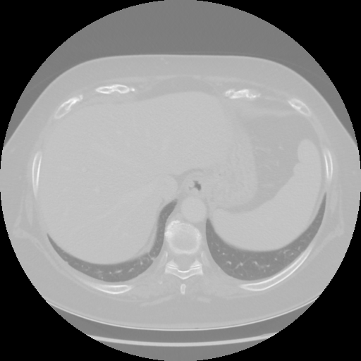 Original VENOUS CT scan