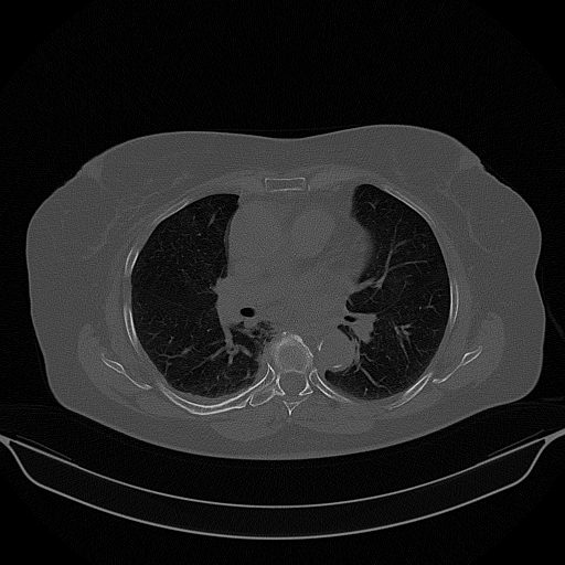 Original NATIVE CT scan (input)
