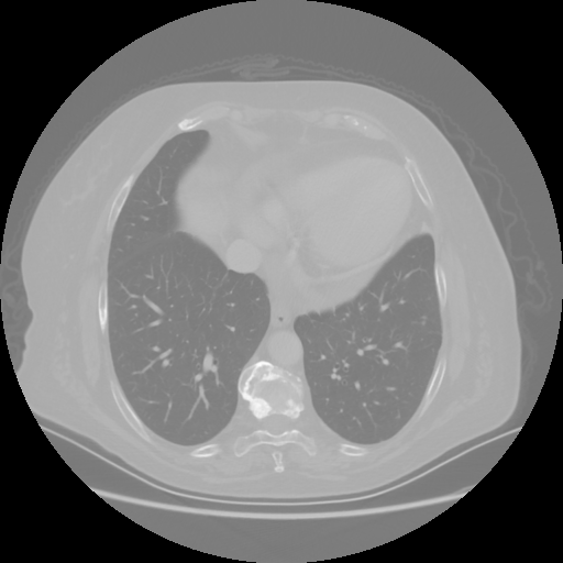 Original VENOUS CT scan
