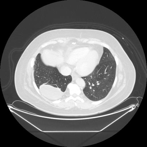 Original VENOUS CT scan
