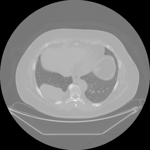 Original NATIVE CT scan (input)