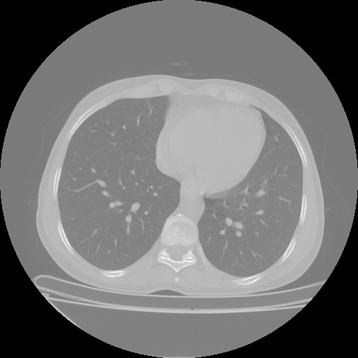 Original NATIVE CT scan (input)