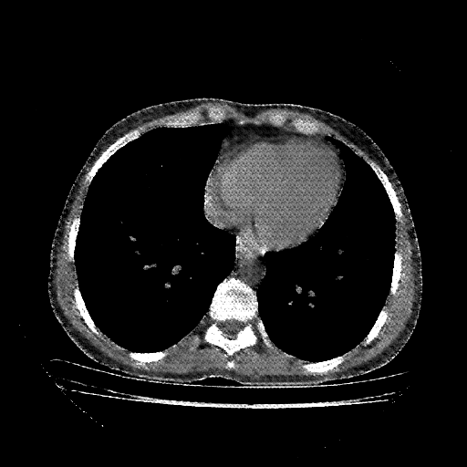 Reconstructed NATIVE CT scan (cycle consistency)