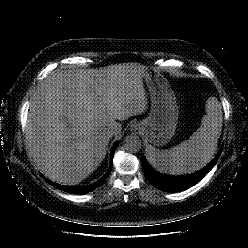 Generated VENOUS CT scan (A→B translation)