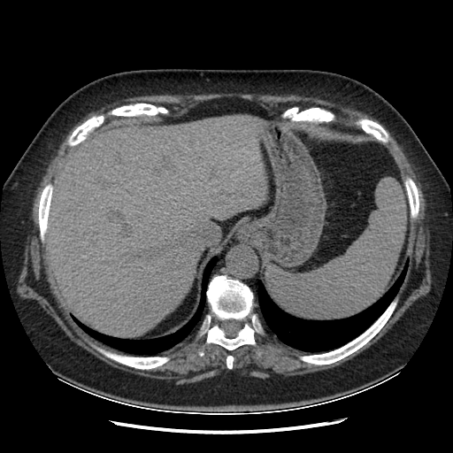 Original NATIVE CT scan (input)