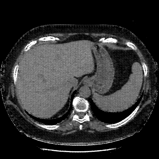 Reconstructed NATIVE CT scan (cycle consistency)