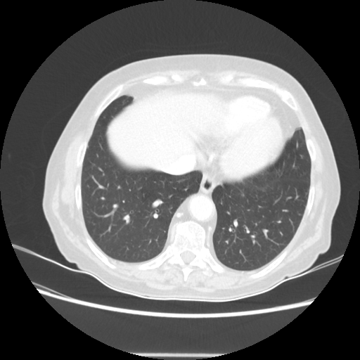 Original VENOUS CT scan