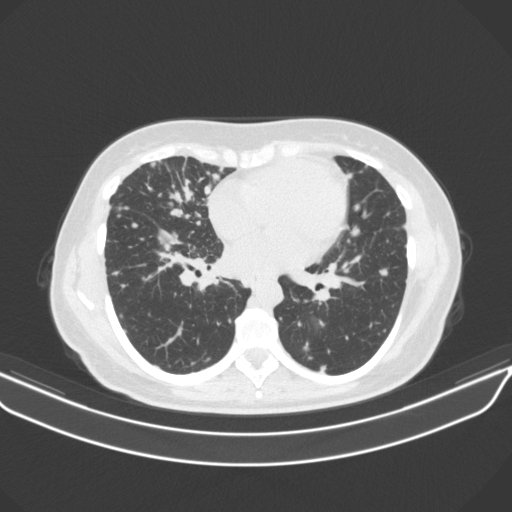 Original NATIVE CT scan (input)