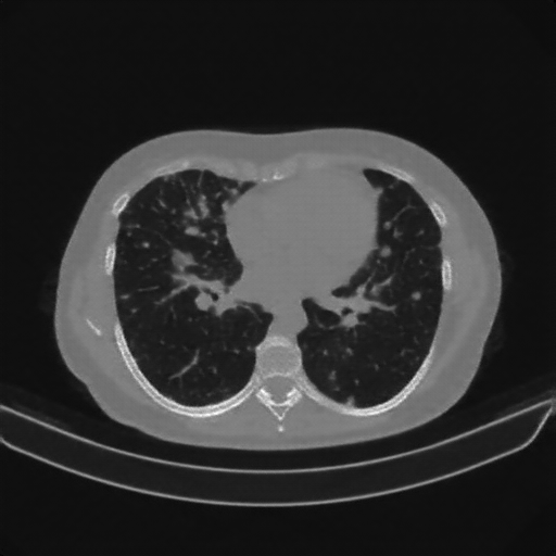 Reconstructed NATIVE CT scan (cycle consistency)