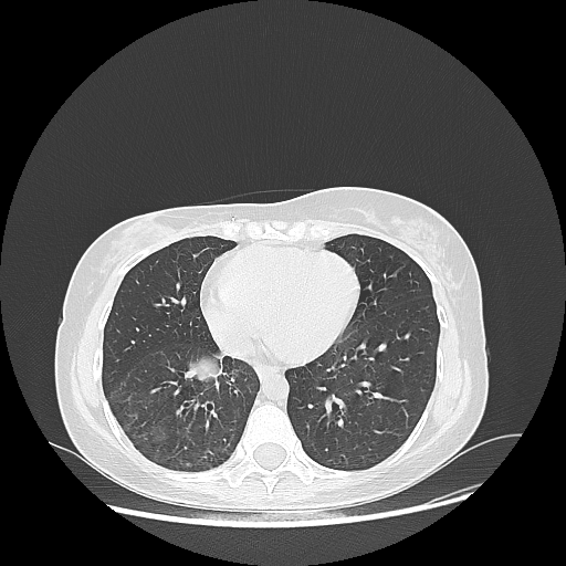 Original NATIVE CT scan (input)