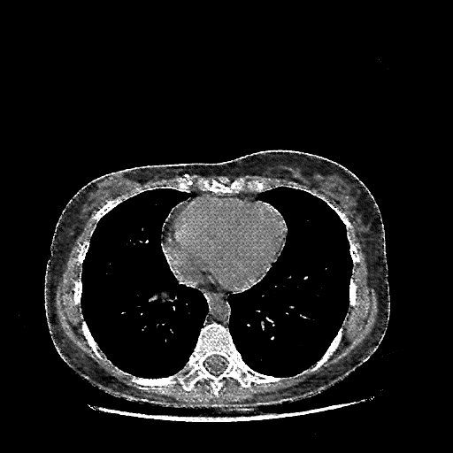 Reconstructed NATIVE CT scan (cycle consistency)