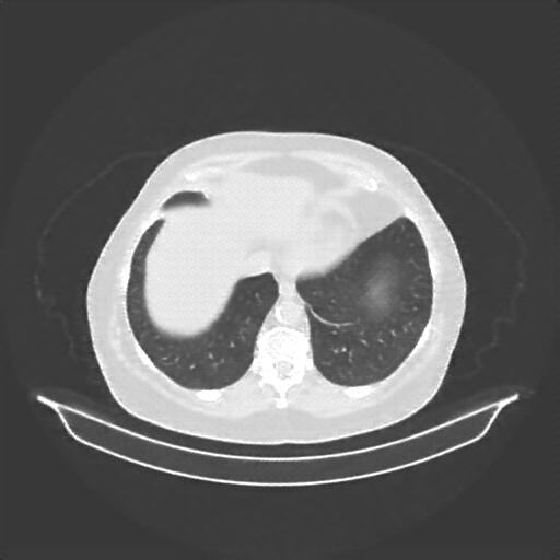 Reconstructed NATIVE CT scan (cycle consistency)