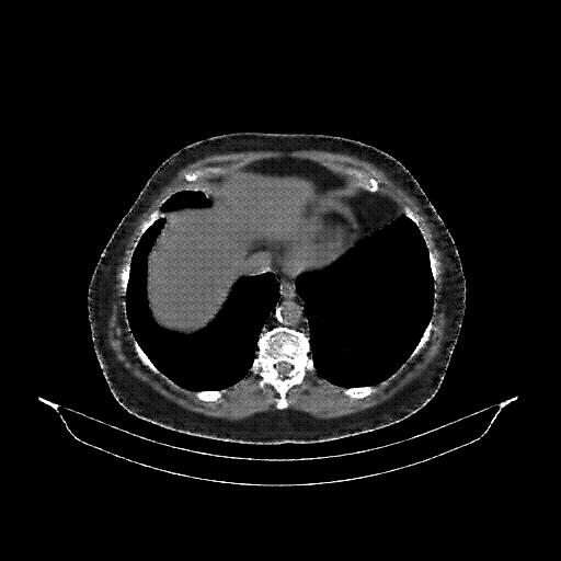 Reconstructed NATIVE CT scan (cycle consistency)