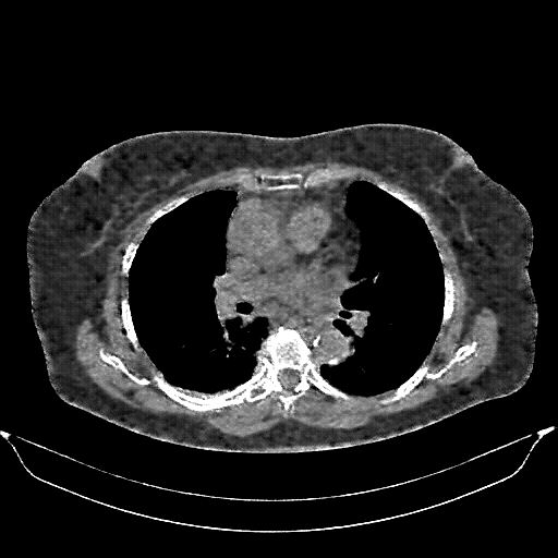Reconstructed NATIVE CT scan (cycle consistency)