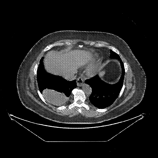 Reconstructed NATIVE CT scan (cycle consistency)