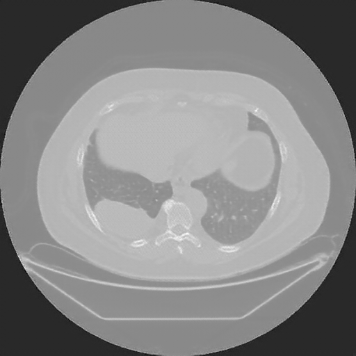 Reconstructed NATIVE CT scan (cycle consistency)