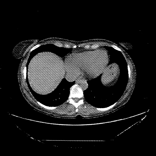 Generated VENOUS CT scan (A→B translation)