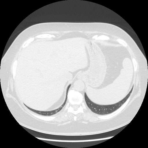 Original NATIVE CT scan (input)