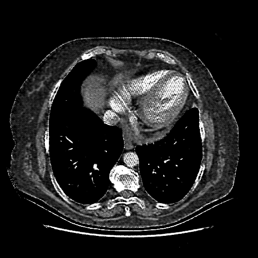 Reconstructed NATIVE CT scan (cycle consistency)