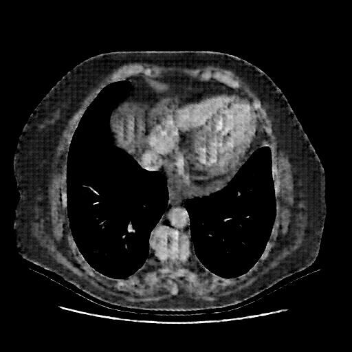 Reconstructed NATIVE CT scan (cycle consistency)