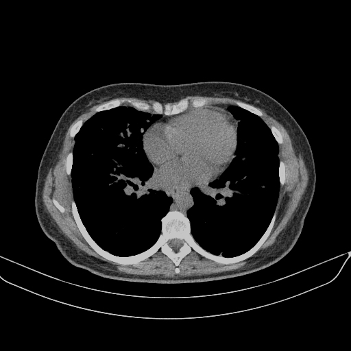 Original NATIVE CT scan (input)