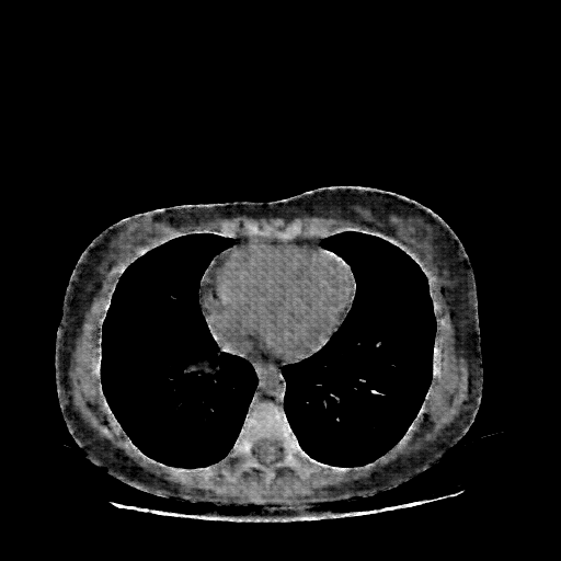 Reconstructed NATIVE CT scan (cycle consistency)
