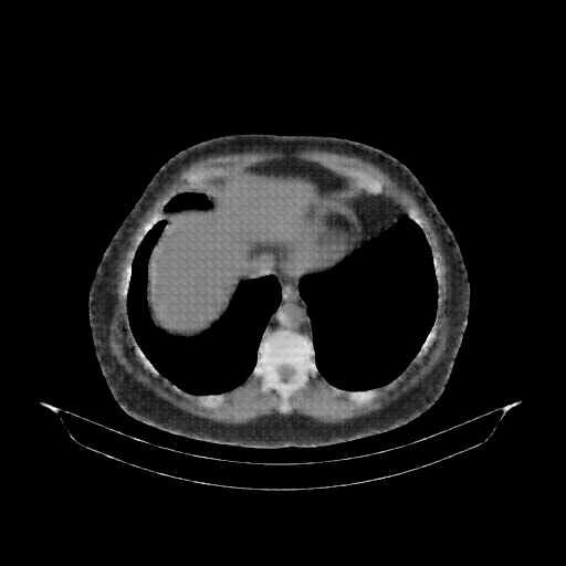 Reconstructed NATIVE CT scan (cycle consistency)