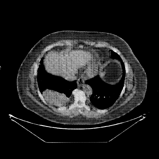 Generated VENOUS CT scan (A→B translation)