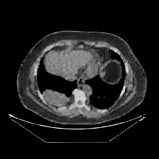 Reconstructed NATIVE CT scan (cycle consistency)
