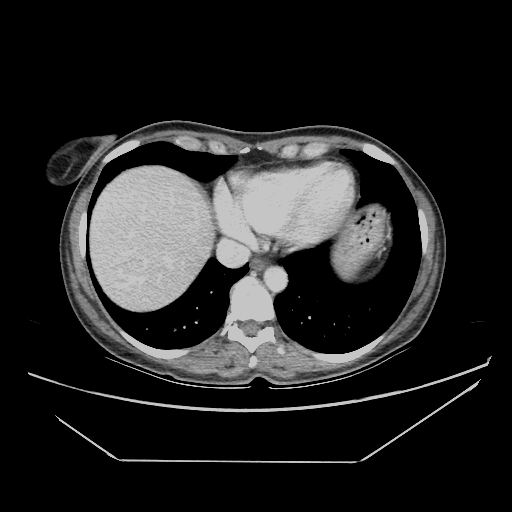 Original VENOUS CT scan
